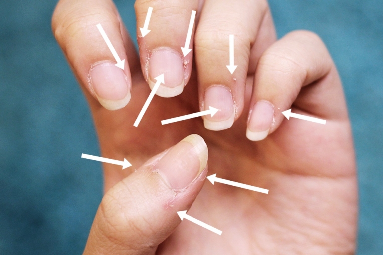 Projekt: Rescue the nails!